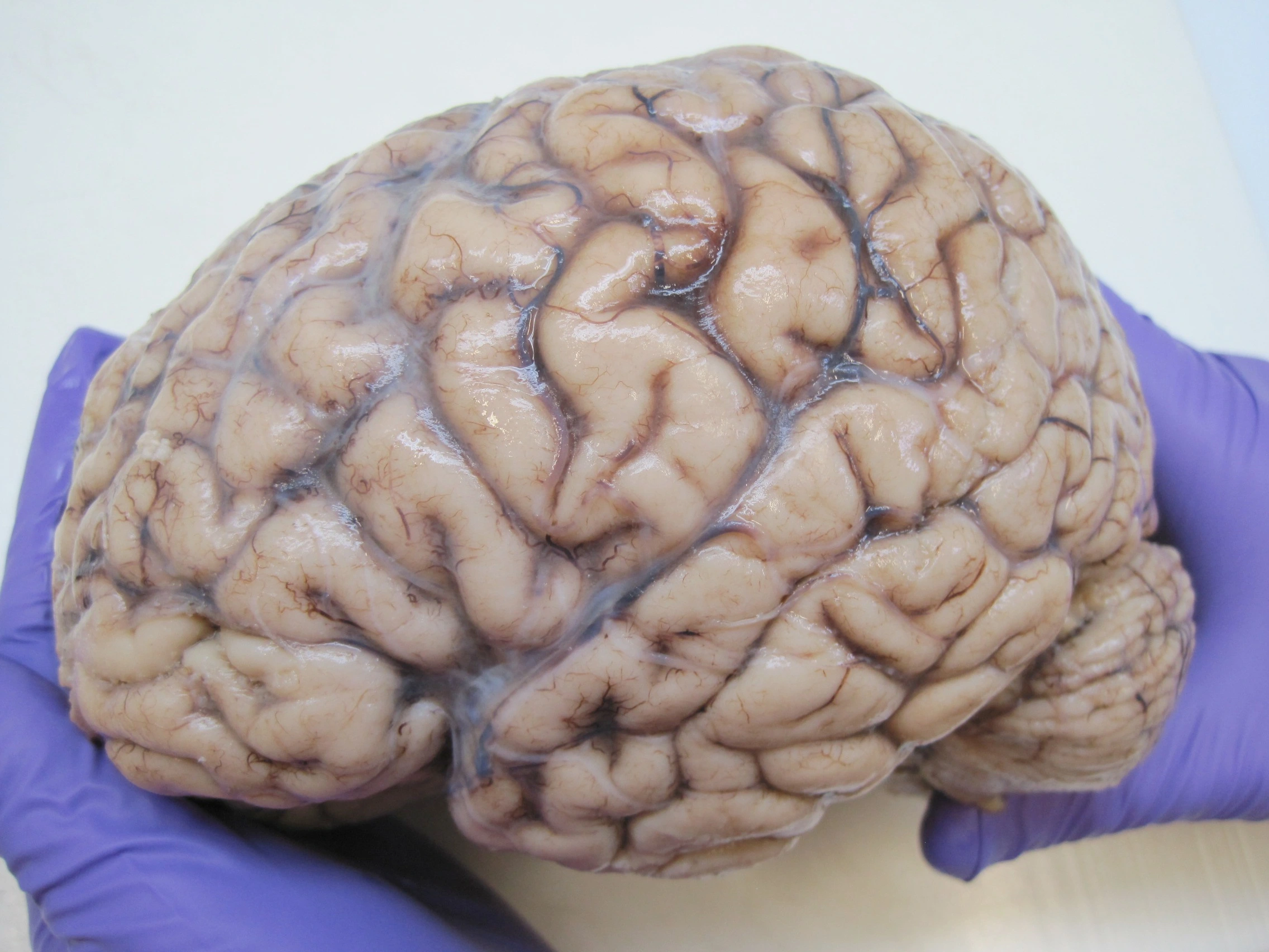 Brain_autopsy_lateral_view